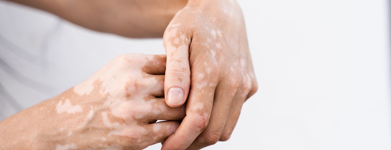 Von Vitiligo betroffene Hände