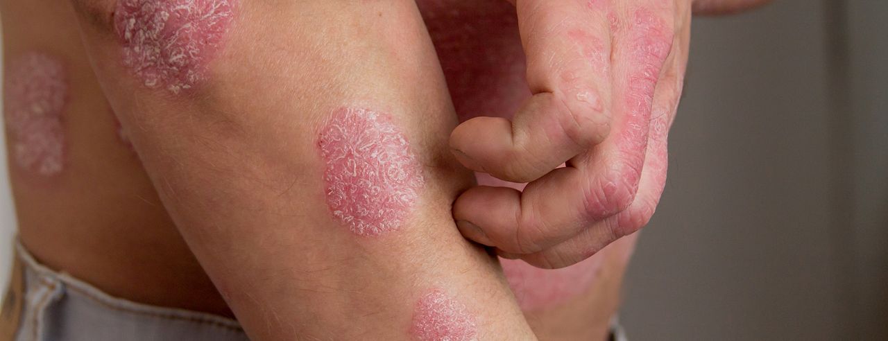 Person mit Psoriasis kratzt sich am Arm