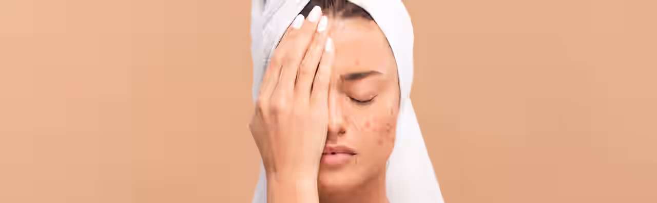 Eine Frau mit Akne hält sich die eine Gesichtshälfte zu.