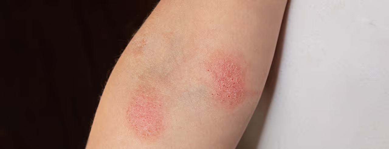 Ein Arm mit Mycosis fungoides