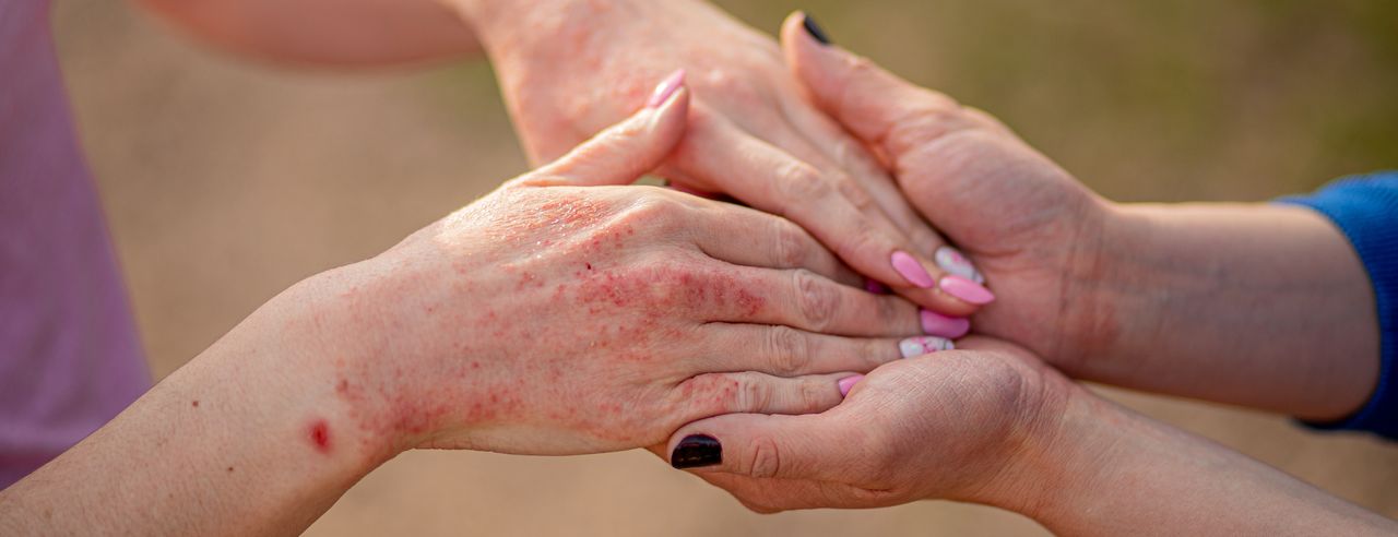 Eine Frau hält die Hände einer Psoriasis-Patientin