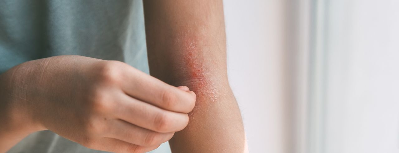 A woman with atopic eczema scratches her arm