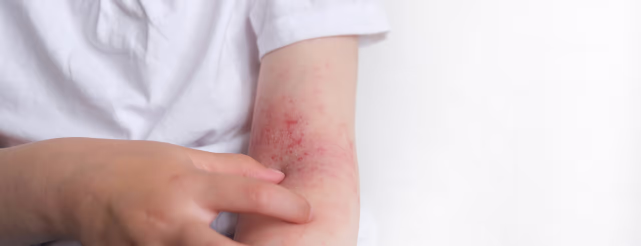 Un enfant atteint de dermatite atopique se gratte le bras