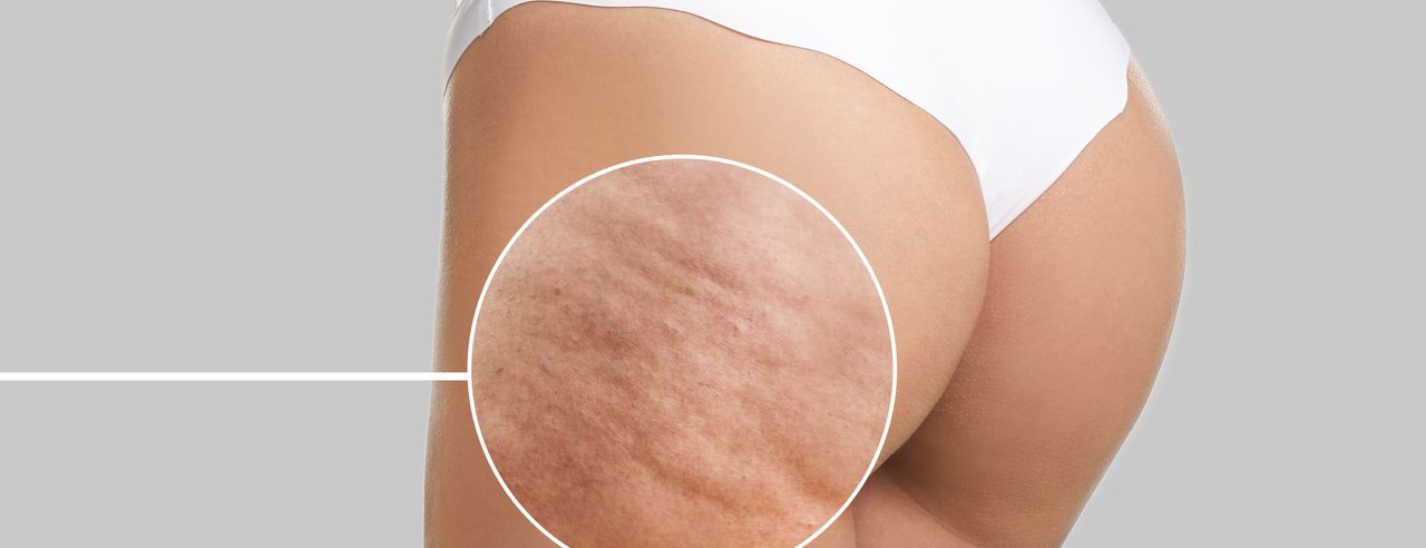 Buttocks of a woman with cellulite