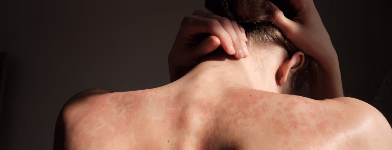 Mensch mit Psoriasis auf dem Rücken