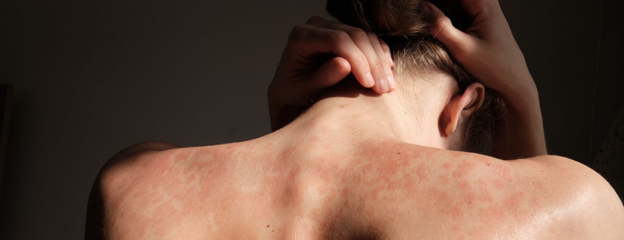 Mensch mit Psoriasis auf dem Rücken