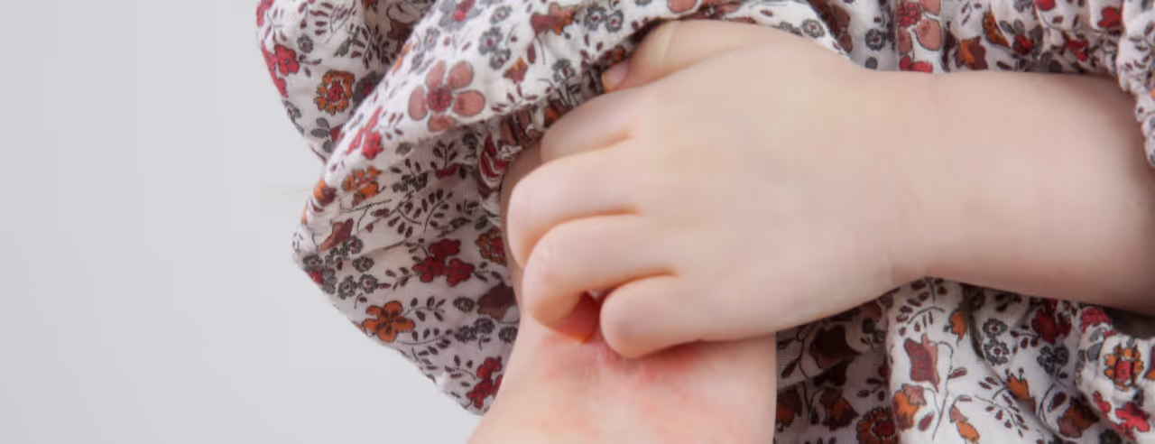 El brazo de un niño con dermatitis atópica