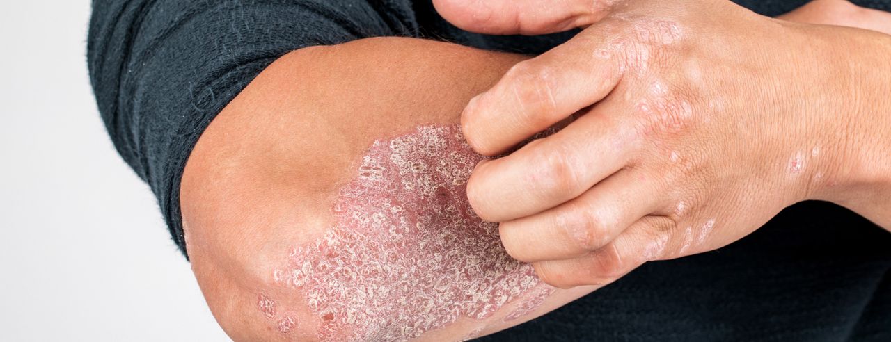 Mann mit Psoriasis kratzt sich am Arm