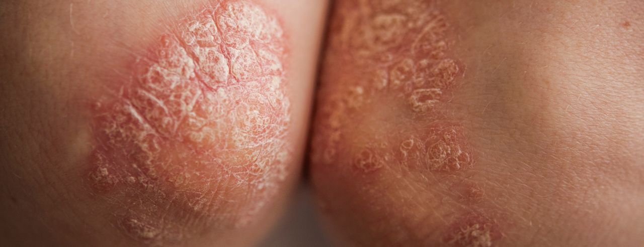 Ellenbogen mit Psoriasis