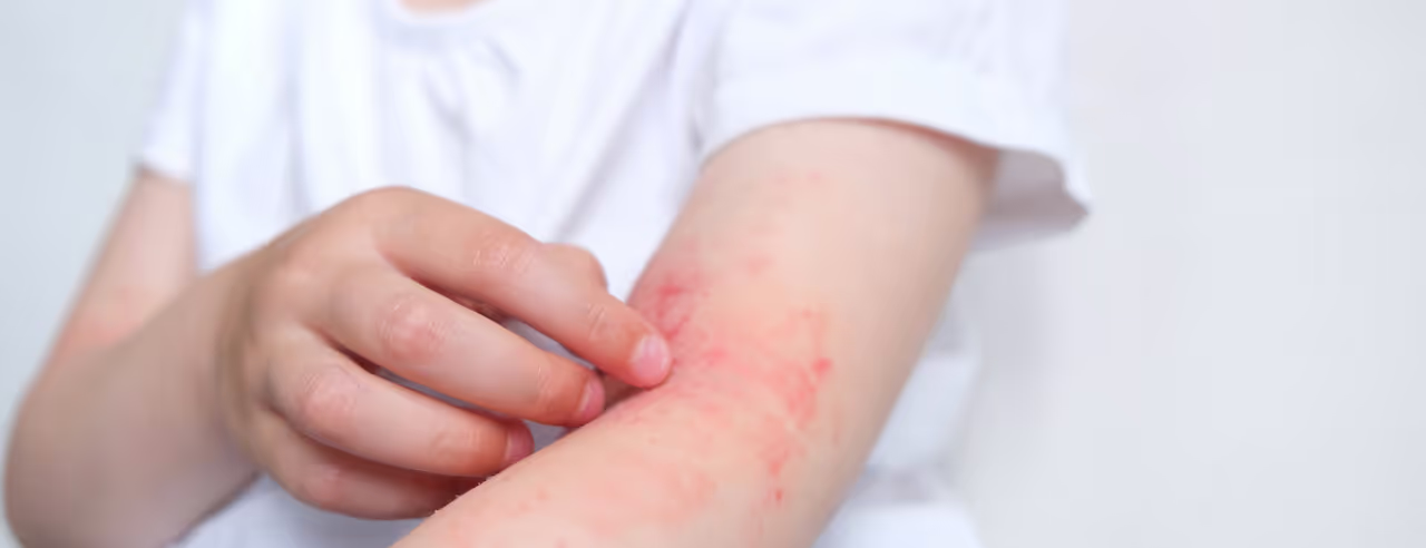 Child with atopic eczema scratches his arm